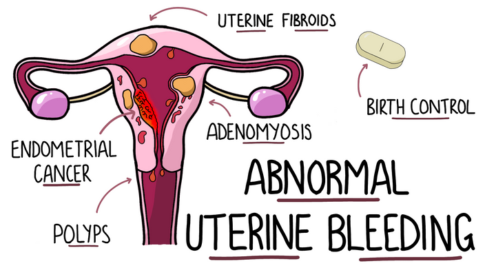 Abnormal Uterine Bleeding