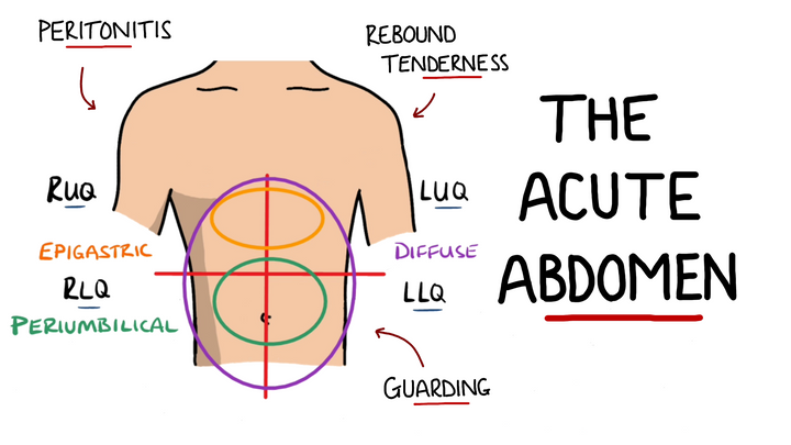 Acute Abdomen