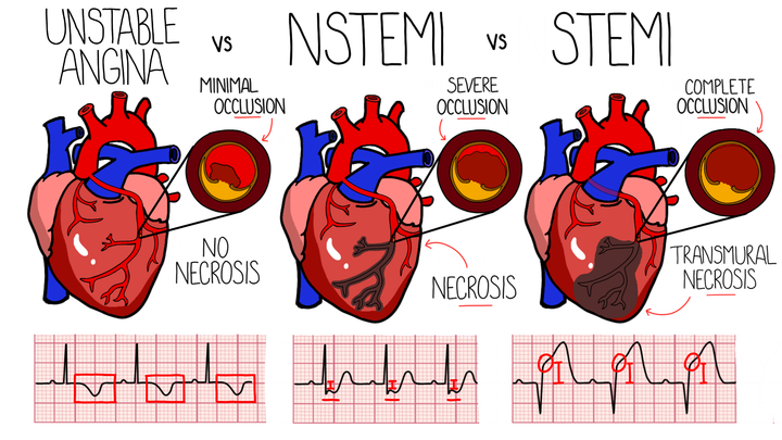Acute Coronary Syndrome