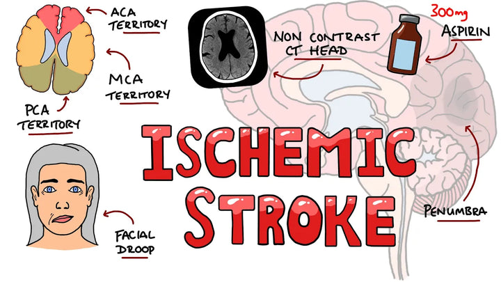 Acute Ischemic Stroke