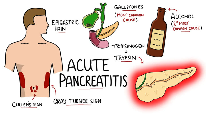 Acute Pancreatitis