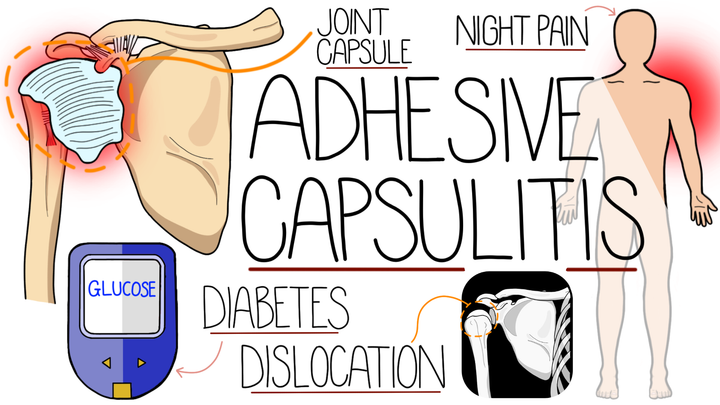 Adhesive Capsulitis (Frozen Shoulder)