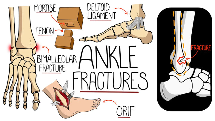 Ankle Fractures