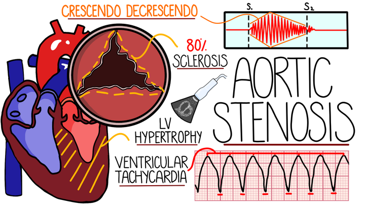Aortic Stenosis