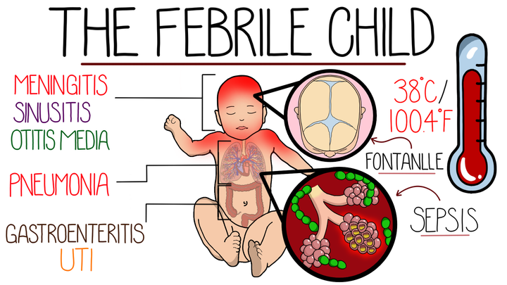Approach to Fever in Children & Infants