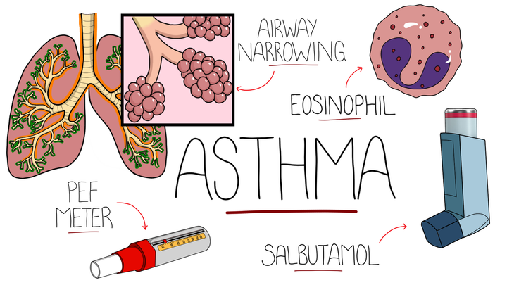 Asthma