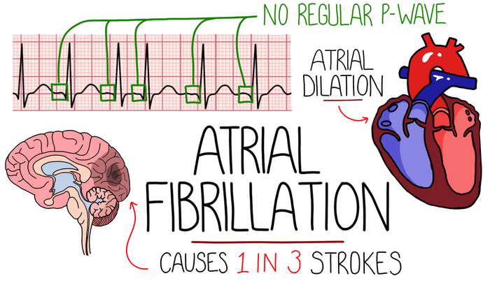 Atrial Fibrillation