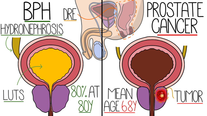 Benign Prostatic Hyperplasia vs Prostate Cancer