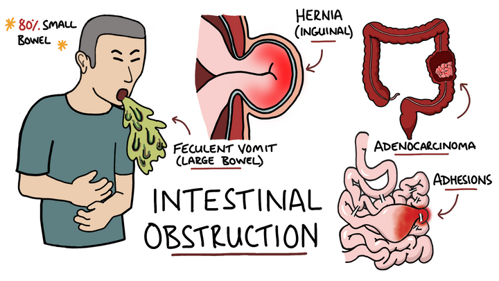 Intestinal Obstruction