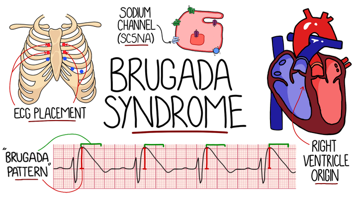 Brugada Syndrome