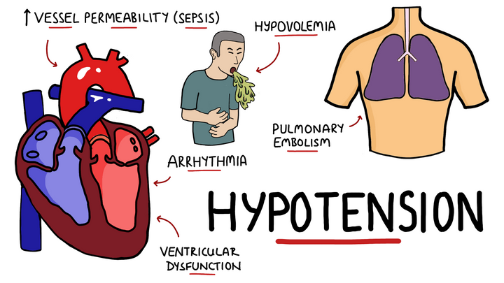 Hypotension