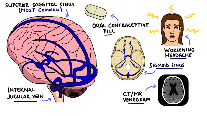 Cerebral Venous Sinus Thrombosis 