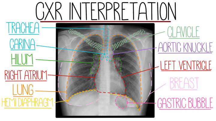 Chest X-Ray Interpretation