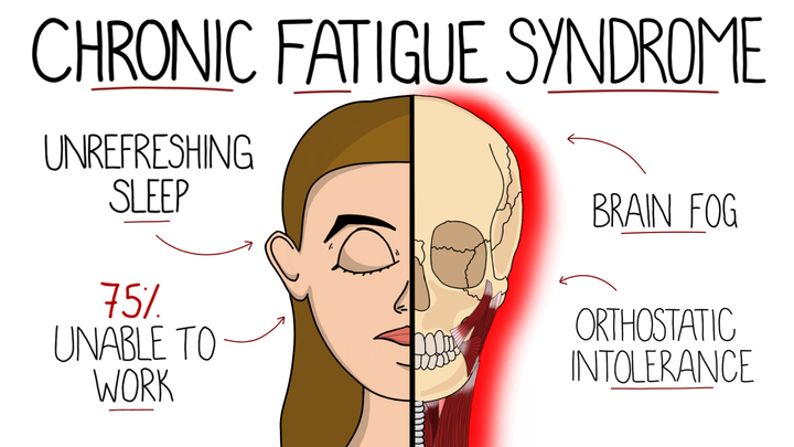 Chronic Fatigue Syndrome