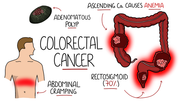 Colorectal Cancer