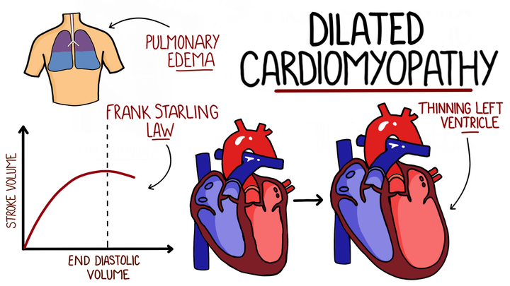 Dilated Cardiomyopathy