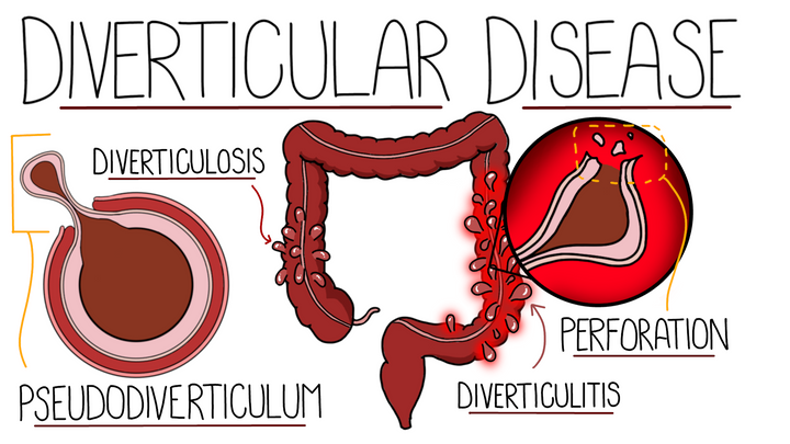 Diverticular Disease