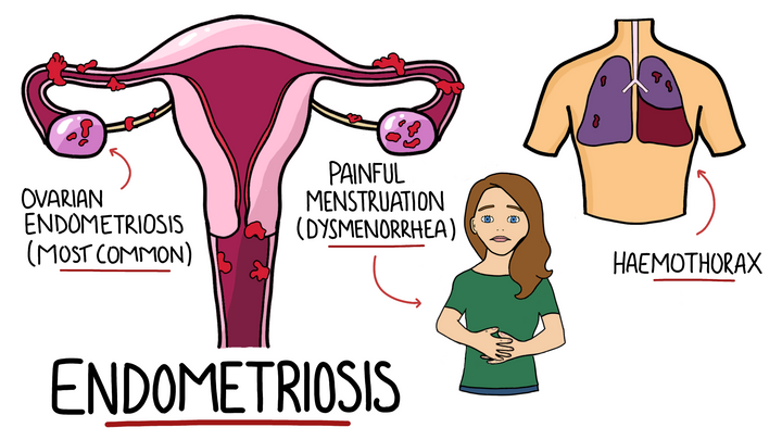 Endometriosis 