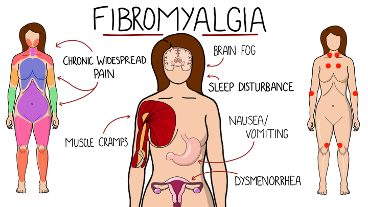 Fibromyalgia