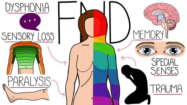 Functional Neurological Disorder
