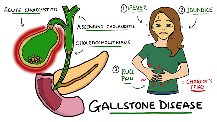 Gallstone Disease
