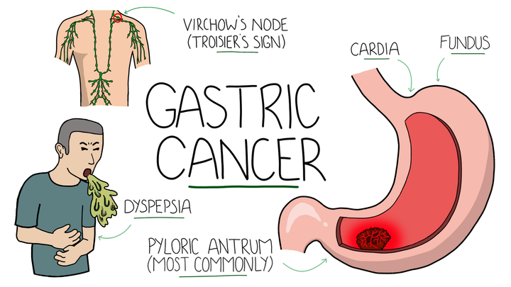 Gastric Cancer