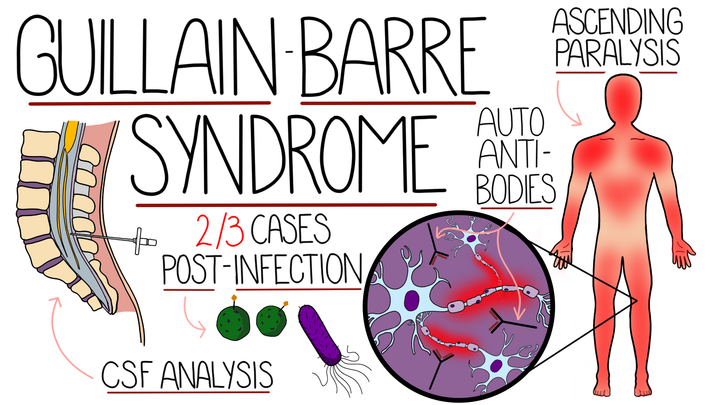 Guillian Barre Syndrome
