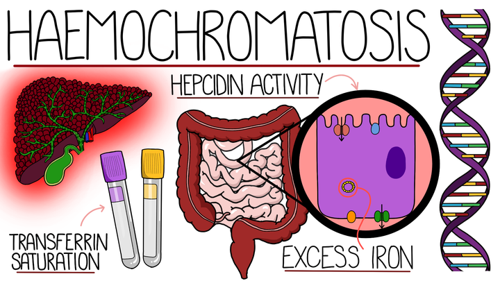 Haemochromatosis 