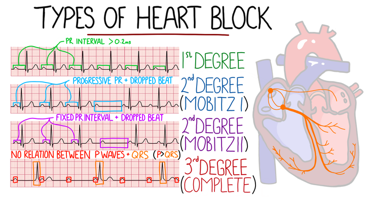 Atrioventricular Blocks (1st-3rd AV Block)