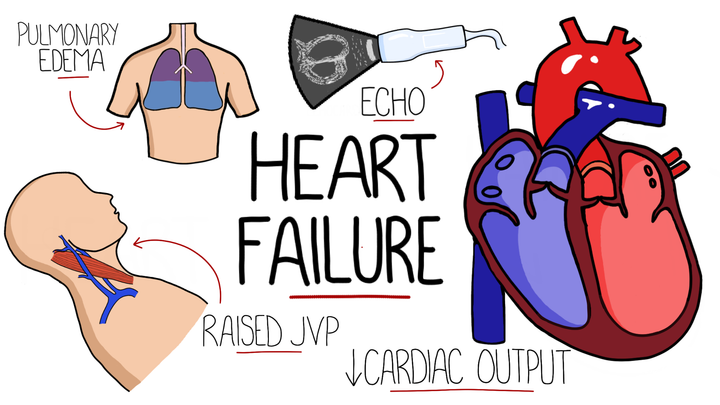 Heart Failure