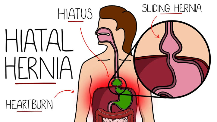 Hiatal Hernia