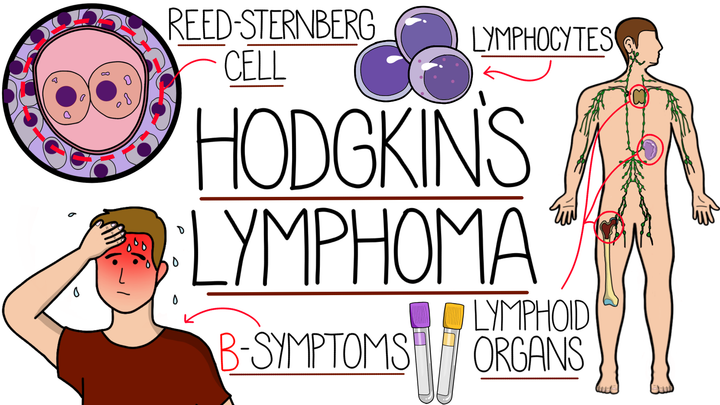 Hodgkin's Lymphoma