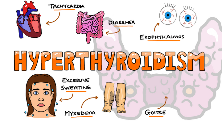 Mnemonic - Symptoms of Hyperthyroidism