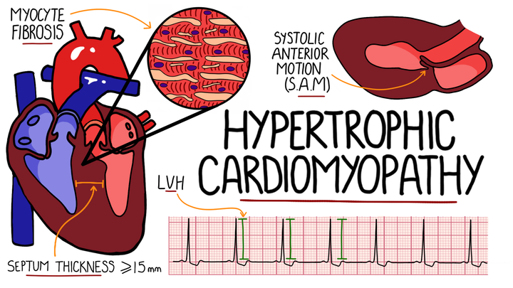 Hypertrophic Cardiomyopathy
