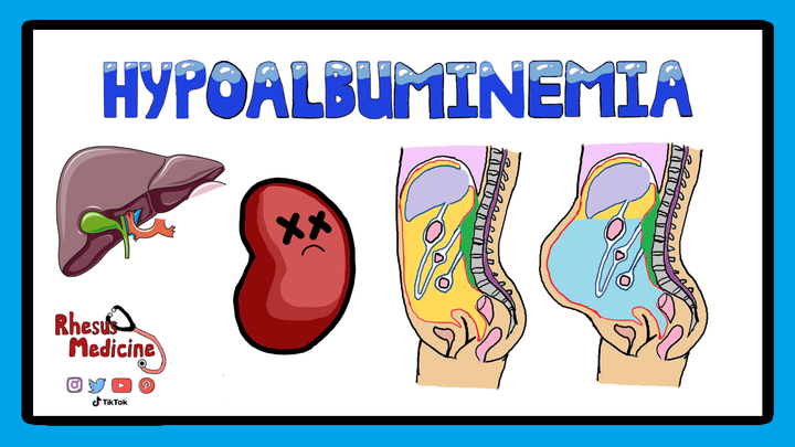 Hypoalbuminemia