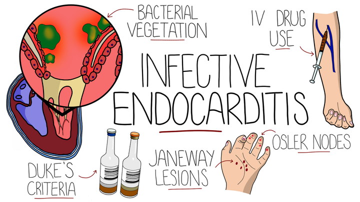 Infective Endocarditis