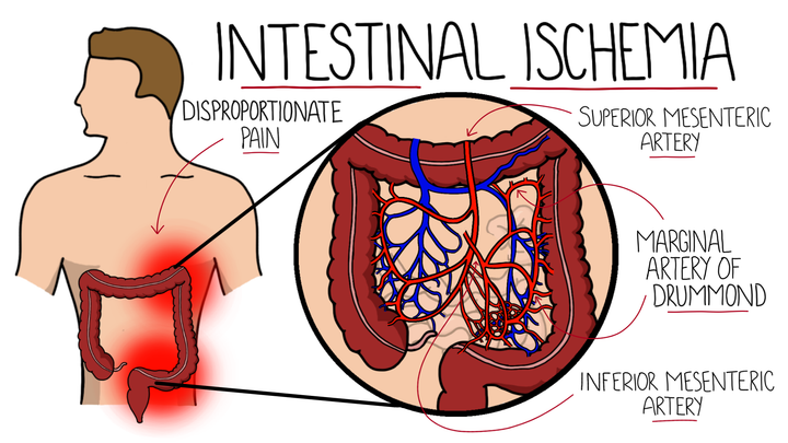 Intestinal Ischemia