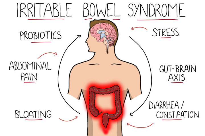 Irritable Bowel Syndrome