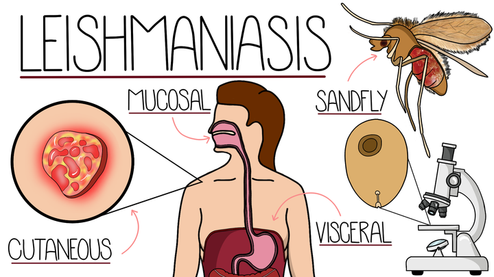 Leishmaniasis