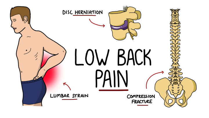 Low Back Pain