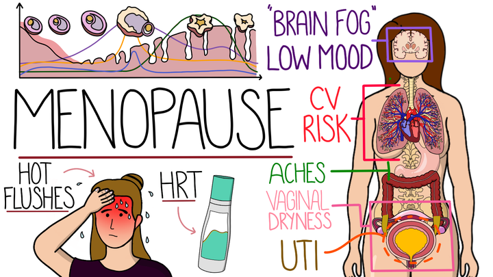 Menopause 