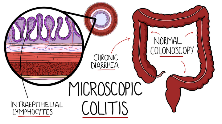 Microscopic Colitis