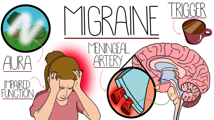 Migraine