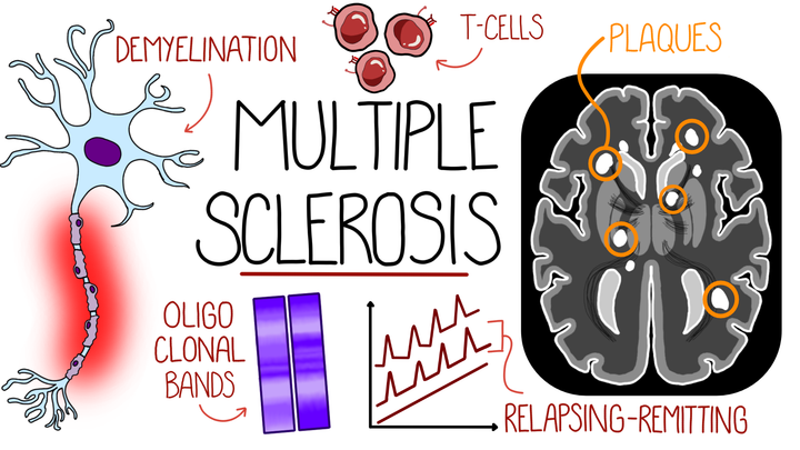 Multiple Sclerosis