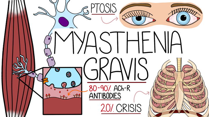 Myasthenia Gravis 