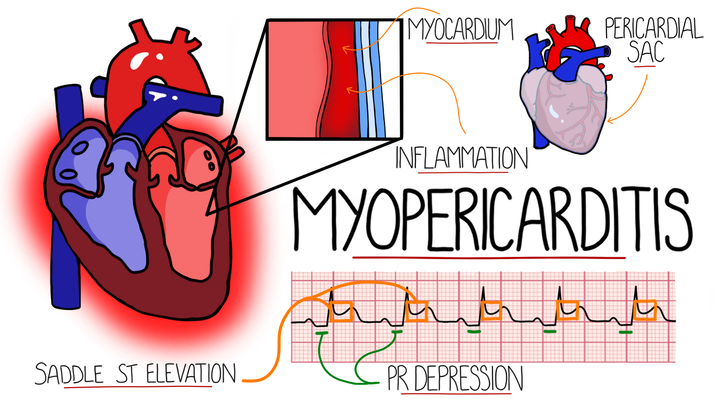 Myopericarditis
