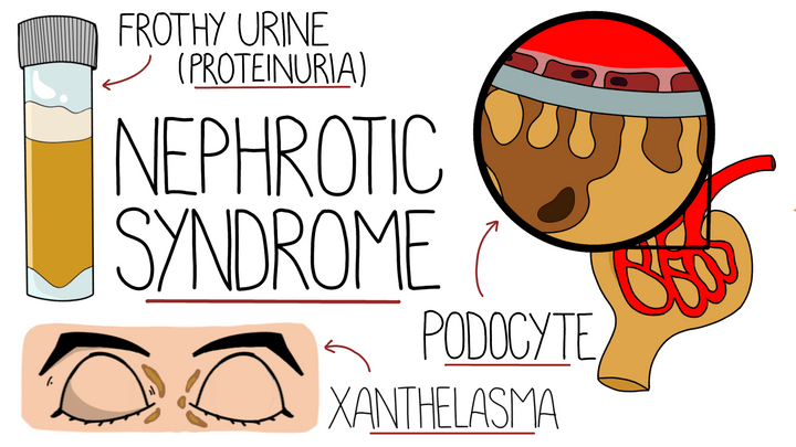Nephrotic Syndrome