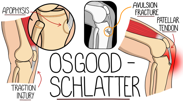 Osgood Schlatter Disease
