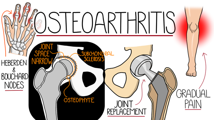 Osteoarthritis 