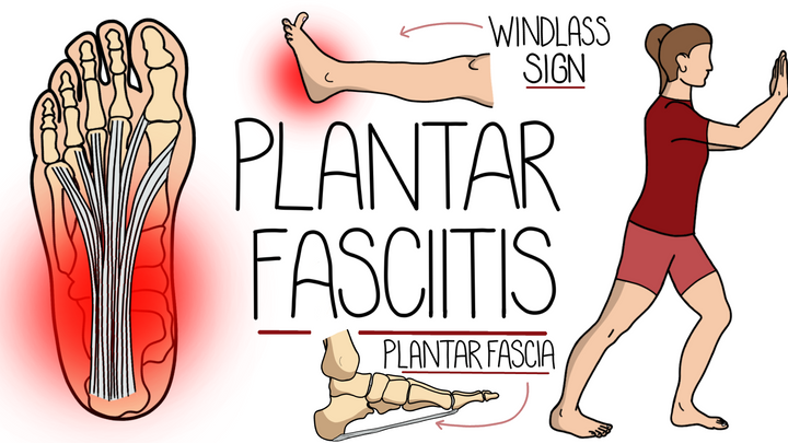 Plantar Fasciitis 